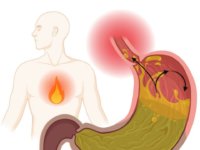 reflux és a lúgos víz